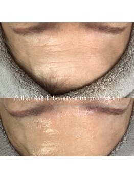 ポレ(pole)/ヒアルロン酸ボ◯ックス要らず★