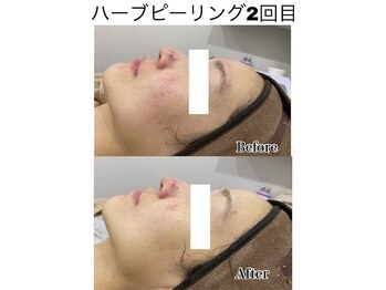 ル ポム バイ ティアム 神戸元町(Le pom by TIAM)/ハーブピーリング