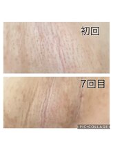 レイモード(Ray mode)/脇脱毛