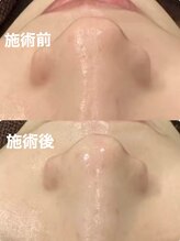 ツール(TOOL)/プラズマシャワー