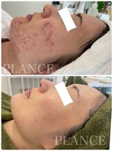 プランス 博多店(PLANCE)/博多　エステ　ニキビケア