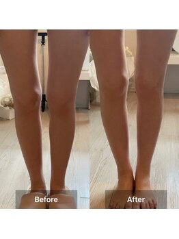 アサヒナ(ASAHINA)/脚のむくみが気になって