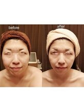 アンジュ/ハイパーナイフ小顔フェイシャル