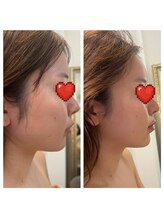 美温(mion)/術前インディバ