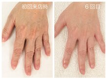 キレイテ 福岡天神店/ハリのなさと血管浮き