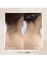 ルミナ(Lumina)/レディース脱毛