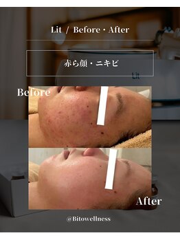 ビトウェルネス 池尻大橋(Bi to wellness)/【赤み・ニキビ】肌育成