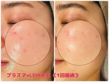 ノア(NOA.)/【韓国人気のニキビケア】