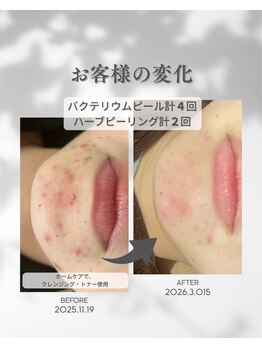 プレジール(Plaisir)/お手入れ6回・ホームケア使用