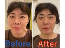 かつらはりきゅう 小児しん/美容鍼＋美容リンパていしん