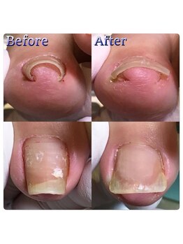 【大阪・京橋】巻き爪