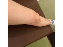 エムスムース(M/Smooth)の雰囲気（施術後）