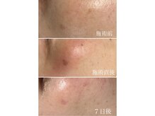 ヴィアージュ(Viage)/シミケア