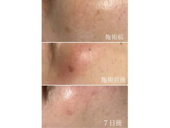 ヴィアージュ(Viage)/シミケア