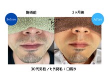 メンズアメリ/高知/メンズ脱毛/ヒゲ/全身/VIO