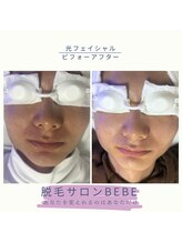 ベベ(Bebe)/光フェイシャル♪