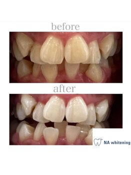 エヌエーホワイトニング たまプラーザ店(NAホワイトニング)/セルフホワイトニング/横浜