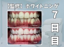 エックス(X)/【監修】ホワイトニング