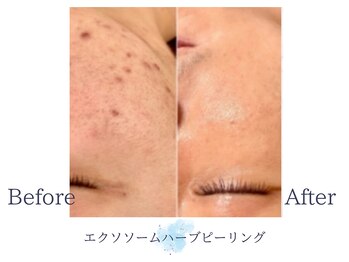 ディアスマイル(Dear.smile)/エクソソームハーブピーリング