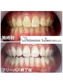 ホワイトニングサロン 京都烏丸店/ホワイトニング施術例