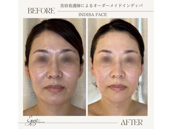 エスプリ(Esprit+)/●インディバ小顔効果