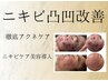 【ニキビによる凸凹ケア改善】ツルツル肌を手に入れる未来が待っているコース