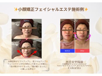 コトリト(Cotorito)/フェイスライン引き締め実感