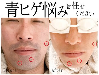 スポット 薬院駅前店(SPOT)の写真/【福岡薬院天神エリア】最安値級ヒゲ脱毛1,000円体験◆都度払い＆サブスクでこの秋から始めよう！