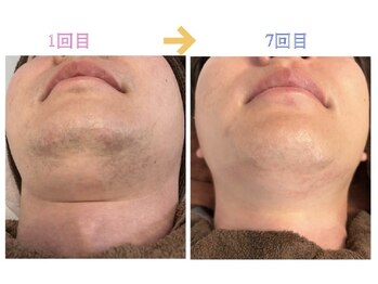 リオンズ 柏駅前店の写真/【人気No.1メンズ脱毛】清潔感で好印象。ヒゲ・全身・足・VIO脱毛☆ハイパワー最新機器・通い放題で効果◎