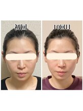 小顔22 ボルティ 本店(Bolty)/Before→After（10回）