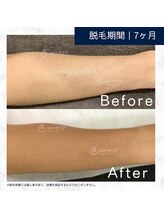 メンズクリア 高知帯屋町店/【メンズクリア】お客様の施術例