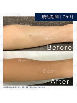 メンズクリア 高知帯屋町店/【メンズクリア】お客様の施術例