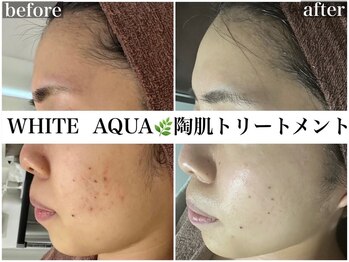 ホワイトアクア 池袋店(WHITE AQUA)/ハーブピーリングで美白ケア