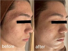 リヴェイラ(RIVEIRA)/グリーンピール5days