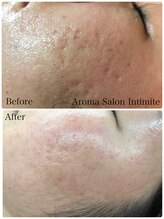 アンティミテ(Intimite)/【スキンケアコース】ニキビケア