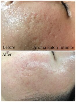 アンティミテ(Intimite)/【スキンケアコース】ニキビケア