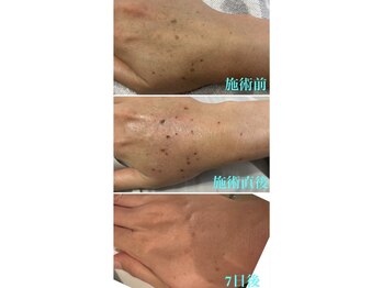 ヴィアージュ(Viage)/シミケア