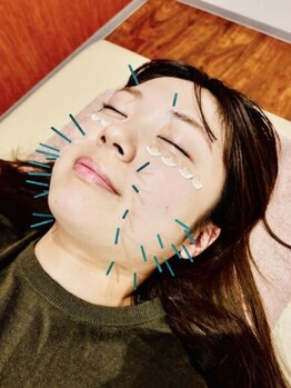 マル整体院(MARU)の写真/むくみ/疲れ/頭痛もまとめてケア◎優しい美容鍼&鍼灸施術!美容鍼（30本）¥8000～・鍼灸施術（身体）¥5500～