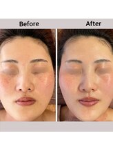 ロッシュ フェイス(Roche Face)/20代女性