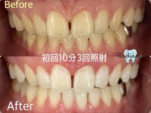 札幌セルフホワイトニング ラディアンス(Radiance)/初回お試しホワイトニング