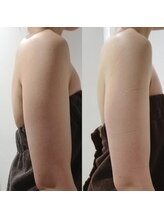 RiとBiのたまご/ドレス集中３回beforeーafter