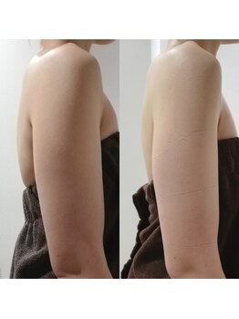 RiとBiのたまご/ドレス集中３回beforeーafter