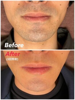 スーパースカルプ 大津店(SuperScalp)/ヒゲ脱毛3回時点before/after