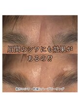 サロンドオフ 西梅田(salon de off)/眉間のシワのビフォーアフター