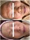 サロンドミュウ(Salon de Mieux)の写真/肌のターンオーバーを整え、シミ・しわも改善◎年齢を感じさせない内側から輝くツヤ美肌へ！