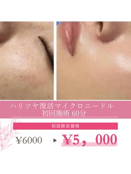 スムース イー(Smooth+E)の写真/【マイクロニードルエイジングケア】自信の持てるピンとハリツヤ肌に♪毛穴/シワたるみ改善におすすめ◎