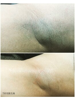 カルム(Calme)/女性 脇脱毛