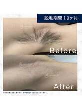 メンズクリア 高知帯屋町店/【メンズクリア】お客様の施術例