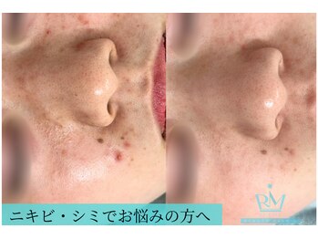 リメイクビューティークリニック(REMAKE BEAUTY CLINIC)/幹細胞ゴールドピーリング