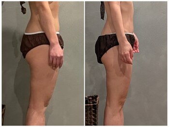 ツーアップ(2up)/前ももパンパン解消